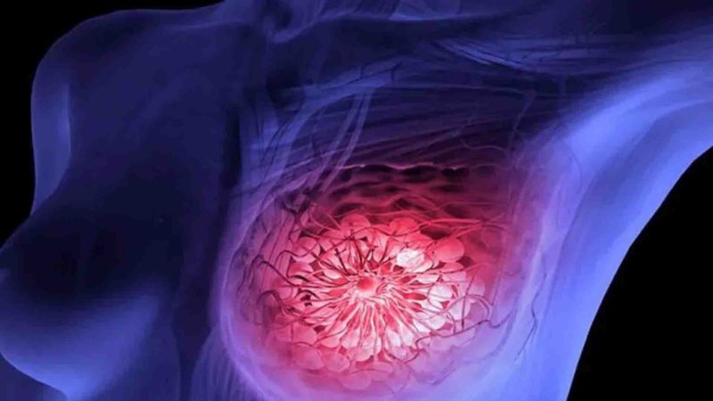 Medicamento para tratar câncer de mama é incorporado ao SUS