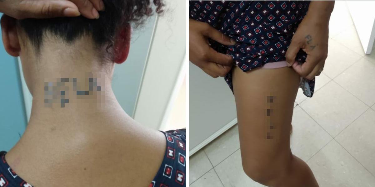 Vítima de agressão, mulher diz ter sido obrigada a tatuar nome do marido pelo corpo