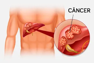 Causas do Câncer de Fígado? Veja sintomas e tratamento