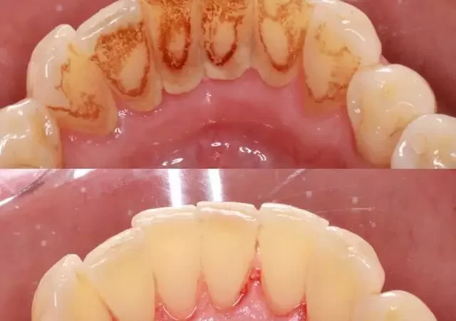 Sabia que o tártaro pode afetar até sua saúde cardíaca? Entenda