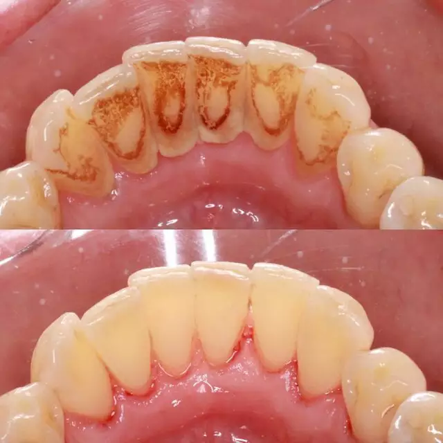 Sabia que o tártaro pode afetar até sua saúde cardíaca? Entenda